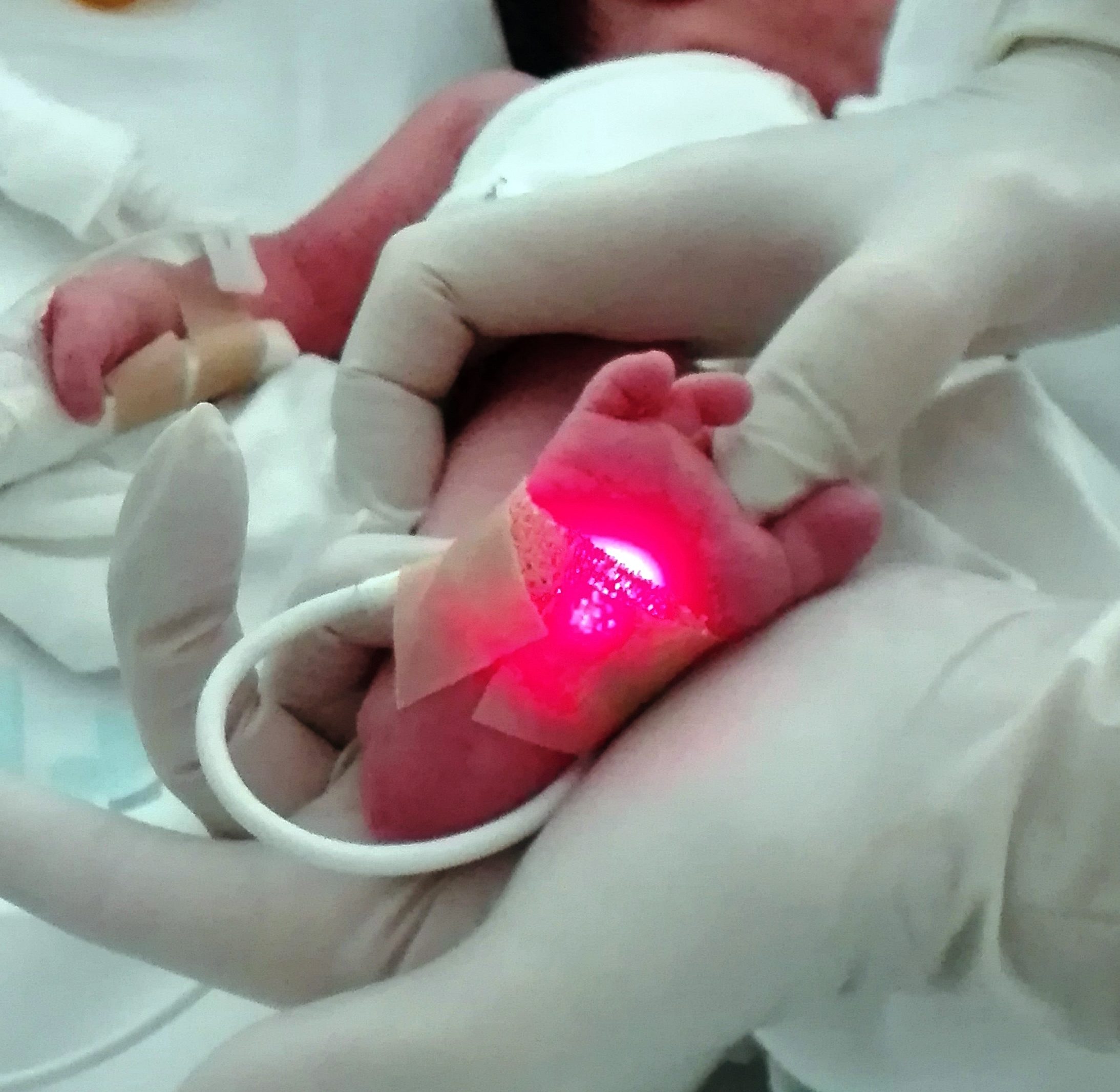 La pulsioximetría, una prueba sencilla para mejorar el diagnóstico neonatal  - Menudos Corazones